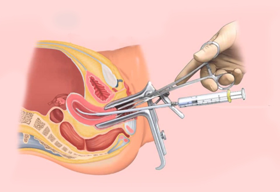 INTRA UTERINE INSEMINATION (IUI)